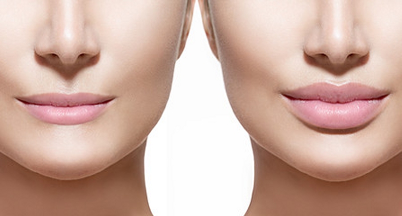 dermal fillers Portsmouth Southampton