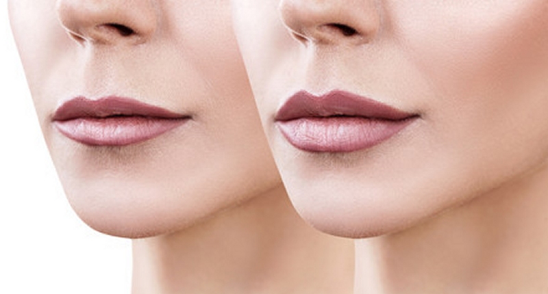 dermal fillers Portsmouth Southampton