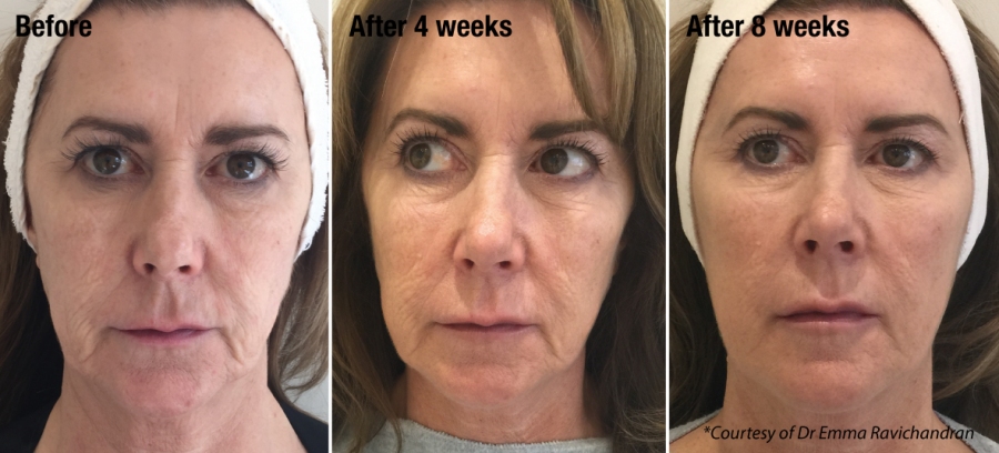 non surgical facelift Portsmouth Southampton